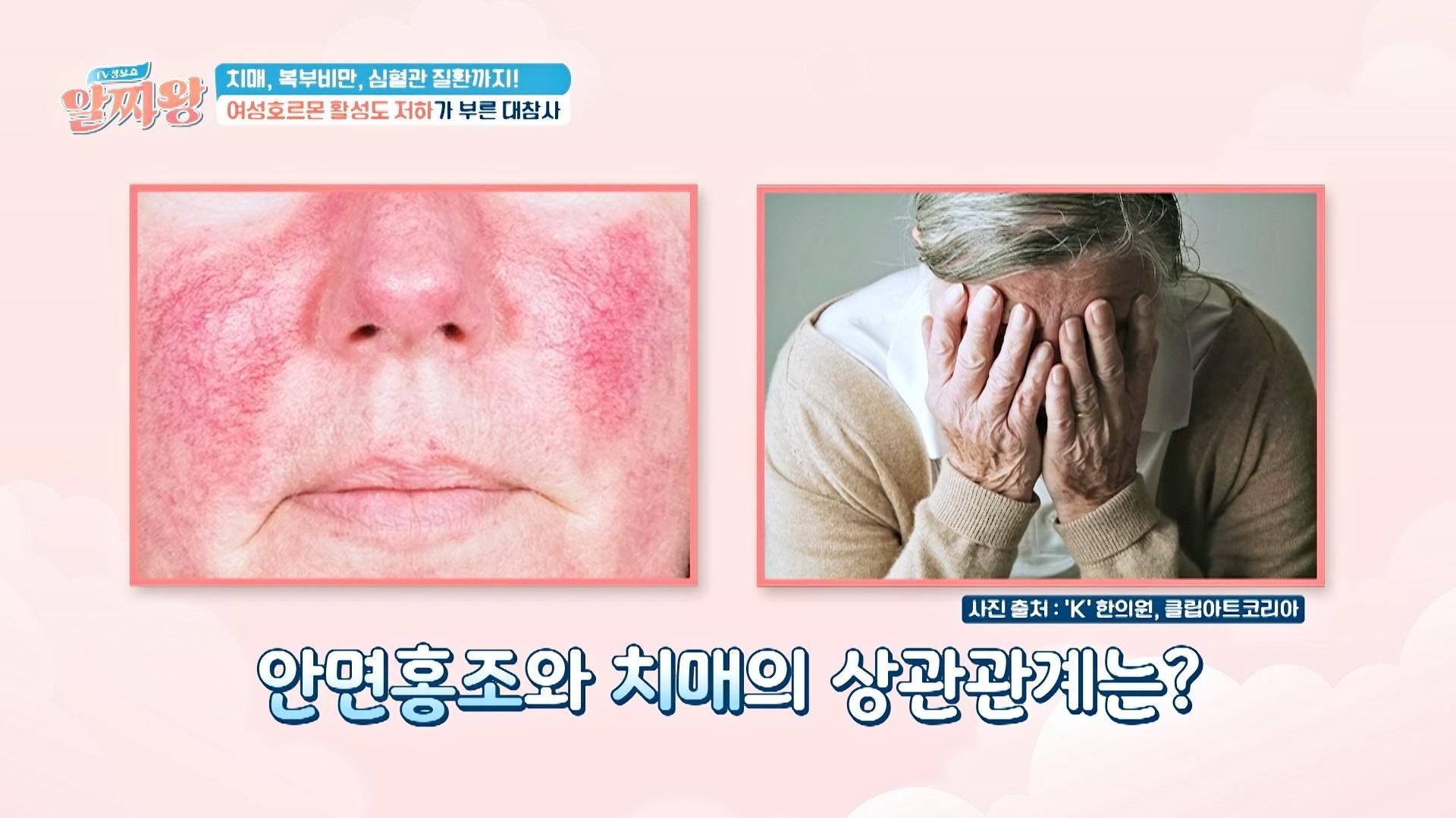 갱년기 대표 증상, 안면홍조가 치매를 유발한다!?😱 | JTBC 240704 방송 | ZUM TV