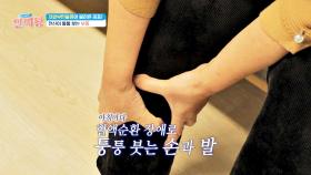 아침마다 퉁퉁 붓는 손과 발💧 