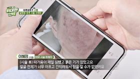 잘못된 피부 시술로 씻을 수 없는 상처를 입은 피해자들... | JTBC 251018 방송