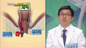 문제적 항문 질환 치질의 정확한 증상들