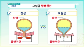 요실금이 발생하는 원인은 무엇일까