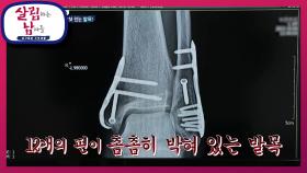 막상 병원에 오니 궁금한게 많으신 장인 어른! 12개의 핀이 박혀있는 발목 | KBS 221105 방송