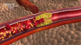 통풍, 목숨 걸고 치료해야 한다! | KBS 250827 방송