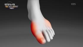 통풍, 당신의 심혈관까지 위협한다 | KBS 250827 방송