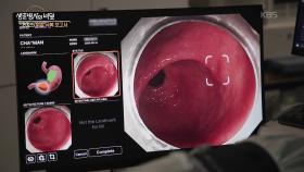 조기 위암, 내시경으로 치료한다! - 내시경 점막하 박리술 | KBS 250910 방송