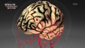 뇌졸중의 숨은 방아쇠- 심장, 잠, 치주염 | KBS 250924 방송