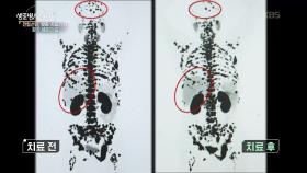거세 저항성 전립선암 환자, 희망은 있다 | KBS 251015 방송