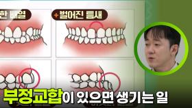 부정교합이 있으면 생기는 일들 | KBS 251123 방송