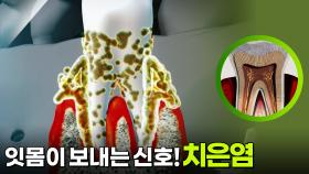 잇몸이 보내는 신호! 치은염 | KBS 251123 방송