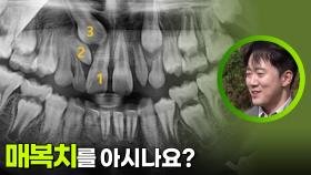 숨어있는 치아, 매복치를 아시나요? | KBS 251123 방송