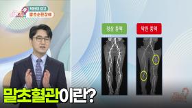 [닥터의 경고] 말초순환장애 | KBS 251215 방송