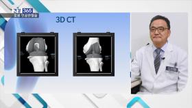[건강365]-로봇 인공관절술, 0.5mm 오차까지 제어