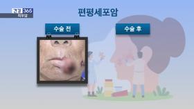 [건강365]-깨끗이 잘라낸 ′피부암′, 남은 목표는 재건