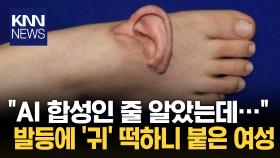 발등에 붙은 ′귀′ 두 눈 의심 특이한 신체 가지게 된 사연은?/ KNN