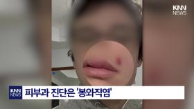 여드름 손으로 짰더니 ′깜짝′ 마비로 응급실행… 무슨 일? / KNN