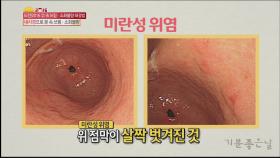 항생제, 진통제가 '위염'의 원인!?