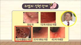 우습게 보면 안 되는 위염, 진행 단계가 있다?