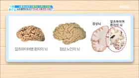 두려운 질병, 치매의 원인은?