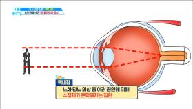 노안 방치가 부르는 실명 질환 '백내장'