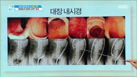 알고 하면 두렵지 않은 위내시경, 대장 내시경!