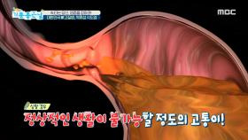 대한민국 新고질병의 정체는? 역류성 식도염!