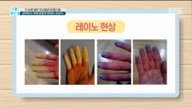 창백하다 못해 파랗게 변하는 손바닥?!