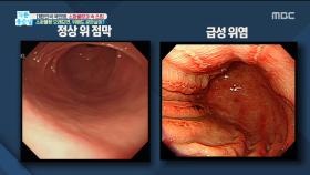 소화불량 오래되면, 위에도 굳은살이?