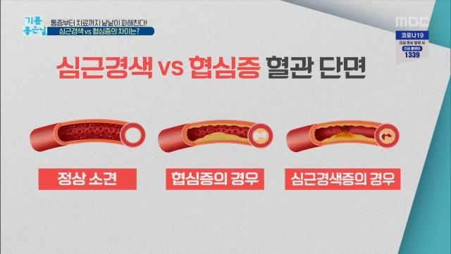 심근경색 vs 협심증의 차이는?