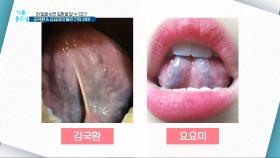 혀 밑을 보면 질환을 알 수 있다? 김국환 & 요요미의 혈관 건강 상태 MBC 201113 방송