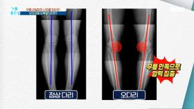 무릎 관절염의 신호를 찾아라! 오다리에 오목발이라면? MBC 201124 방송