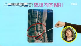 주사로 버튼 이은하의 척추 질환, 척추 전방 전위증!, MBC 210604 방송