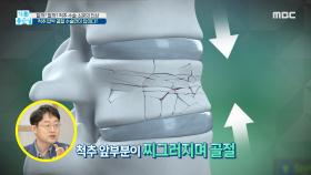 척추 압박 골절, 수술만이 답이다?, MBC 210604 방송