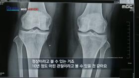 달리기와 무릎 관절염의 상관관계, 보스웰리아가 관절염에 좋은 이유, MBC 240421 방송