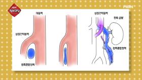 남성 불임을 일으키는 질환, 정계정맥류! 특별한 증상은?
