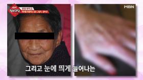 피부를 위협하는 검은 그림자, '검버섯!'