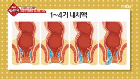 치질의 구분 방법은?