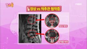 극심한 허리 통증 ＜척추관협착증＞ 제대로 알기