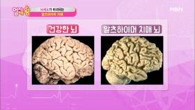 치매에도 종류가 있다?! 알츠하이머 치매 vs 혈관성 치매