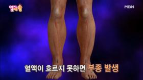 만성피로에 대한 오해와 진실! ＜몸이 부으면 만성피로다?!＞