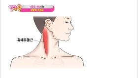 뇌졸중 관리의 핵심! 경동맥 관리!