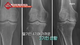 퇴행성 관절염 자가 진단법