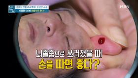 침묵의 살인자, 뇌졸중! 뇌졸중이 오면 손을 따야 한다?