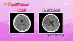 1분에 200만 개의 뇌세포가 죽는다?! 뇌혈관을 막은 혈전 ＜뇌경색＞