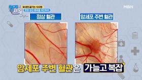 잦은 빈혈과 눈의 실핏줄이 암의 전조증상이다? MBN 201201 방송