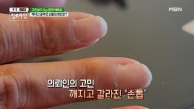 깨지고 갈라진 손톱의 원인은? MBN 210517 방송