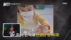 온 몸에 멍이 발견된 2살 입양아 MBN 210715 방송