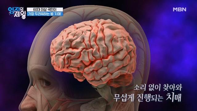 전 세계 치매 환자 약 오천만 명 60대 이상 국민이 가장 두려워 하는 병 치매 Mbn 221122 방송 Zum Tv