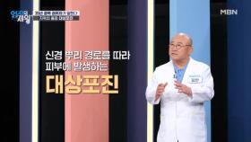 사망까지 이어질 수 있는 고통스러운 병, 대상포진... 통증이 평생 갈 수 있다고? MBN 251209 방송