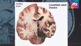 [단독] 올 들어 20대 CJD 의심환자 2명 확인…