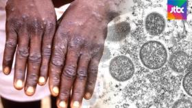 아프리카 희소 감염병 '원숭이두창' 미국·유럽서 발병